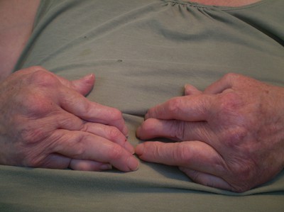 reumatism i fingrar