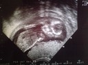 ultraljudsbild bebis 