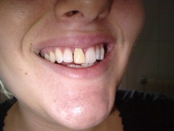 min fina tillfälliga tand som ger mig alla boys!!!!!